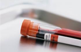 С-реактивный белок в крови: норма в анализах, почему повышается, роль в диагностике