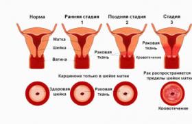 Рак шейки матки: причины, признаки, лечение Определение рака шейки матки